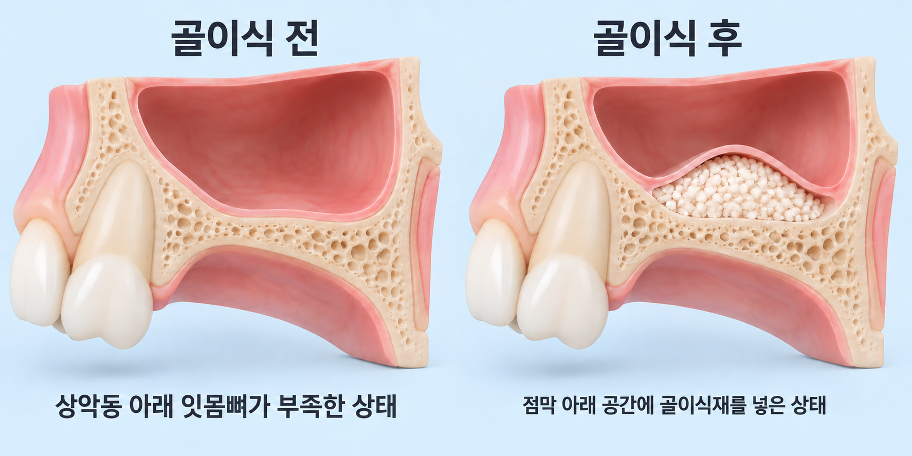 상악동 아래 골이식 공간의 변화를 설명하는 AI 도식, sinus lift and bone graft illustration; 실제 환자 사진 아님