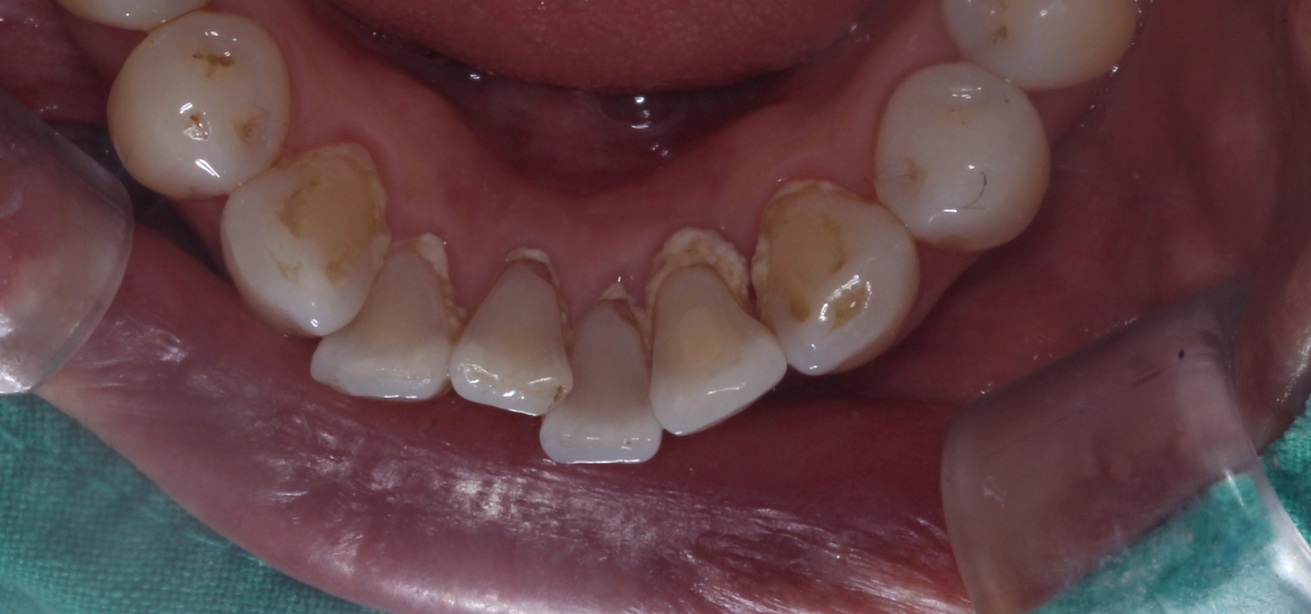 아래 앞니 주변의 착색과 잇몸 경계 부위 치석이 보이는 치료 전 구강사진, lower anterior staining and calculus