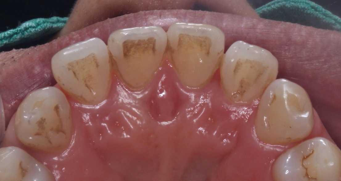 연세위시치과 착색 제거 전 위 앞니 안쪽에 넓게 보이는 갈색 착색, upper anterior tooth staining before treatment