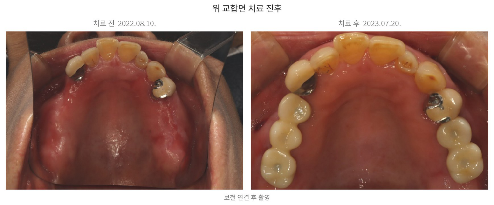 위 오른쪽 세 곳과 왼쪽 두 곳의 어금니 수복 전후를 비교한 교합면 사진, upper molar implant occlusal before and after