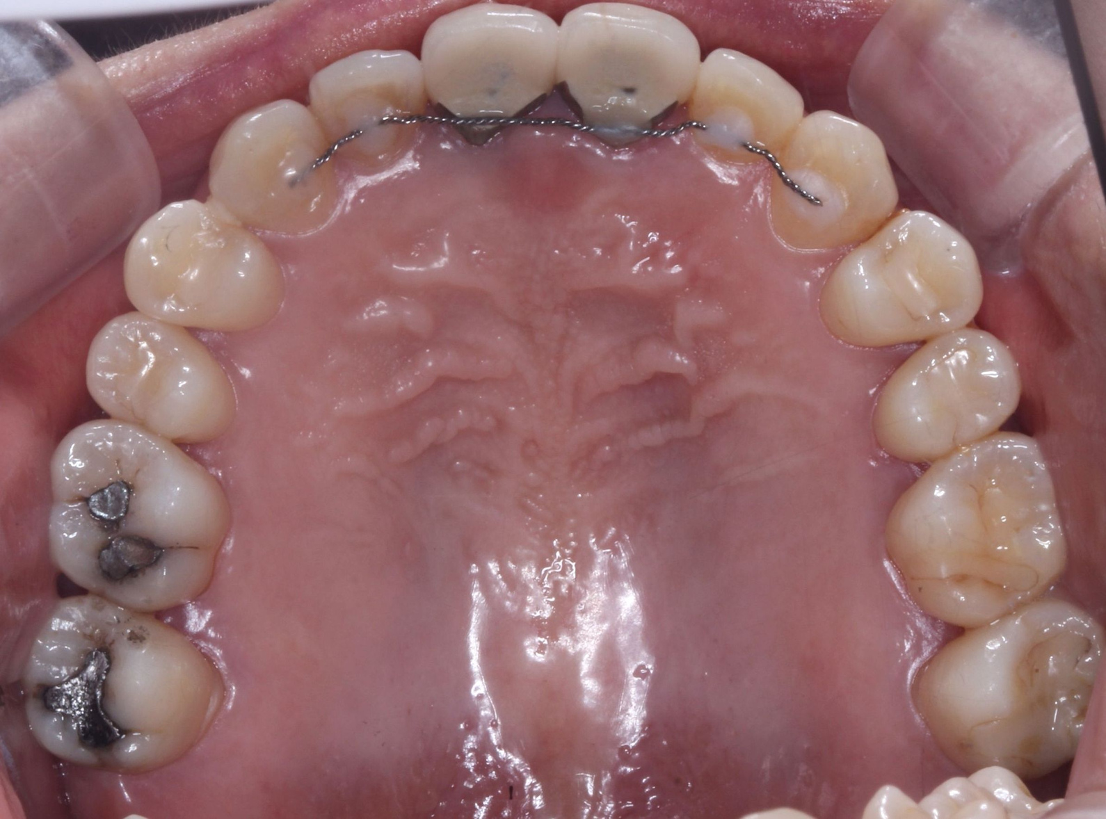 기존 앞니 보철과 교정 유지장치를 확인한 위 교합면